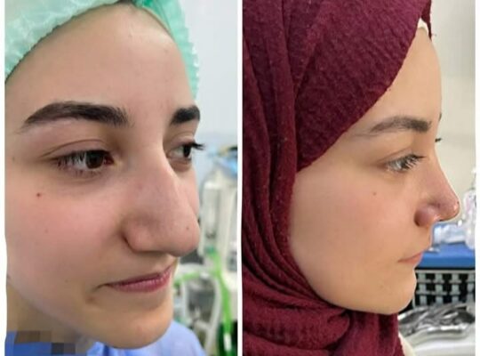الدكتور كنان شريفه _ تجميل الأنف والوجه
