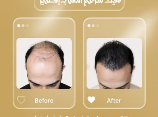 عيادات إكسير لزراعة الشعر
