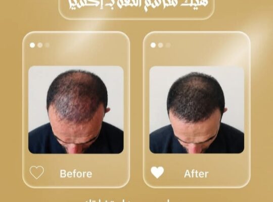 عيادات إكسير لزراعة الشعر